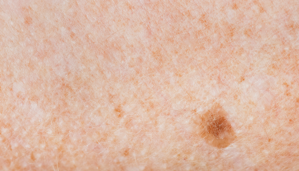Closeup of a skin melanoma